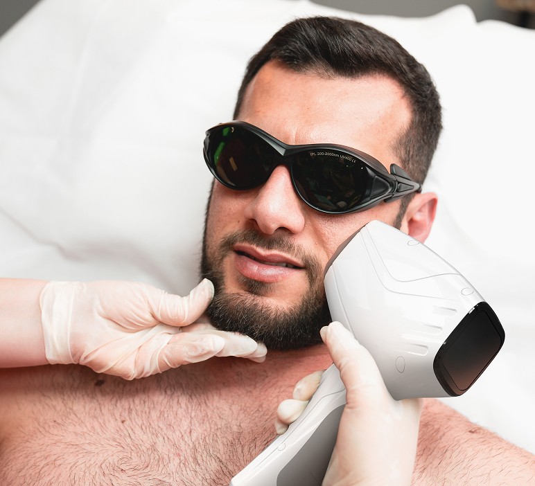 Лазерная эпиляция лица для мужчин 1